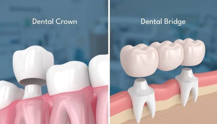 Dental Crown and Bridges Treatment in Mira Road